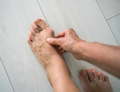 Bunion Treatment Without Surgery: Simple and Effective Ways to Reduce Pain