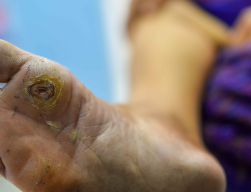 Diabetic Foot Ulcer Treatment: Complete Guide for Better Healing and Foot Care